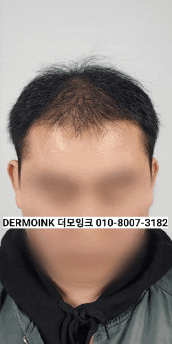  안양 탈모 고민, 휑한 정수리 깔끔하게 커버하는 법