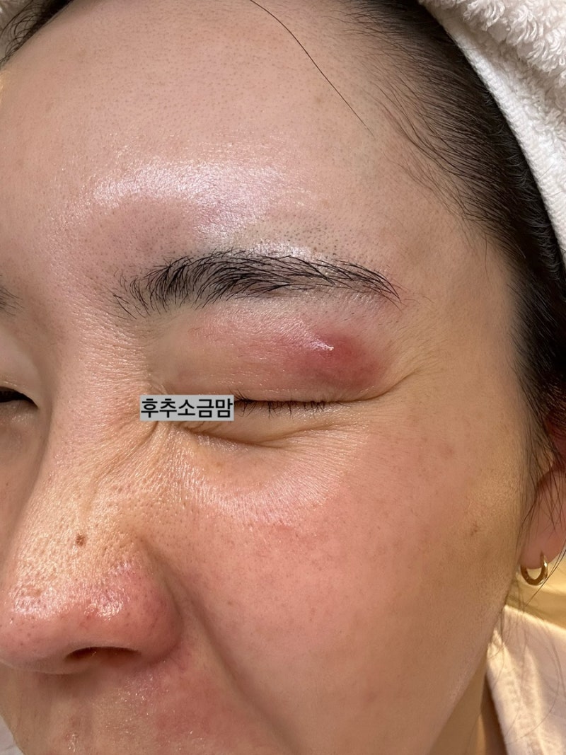 눈에 뭐 남(눈 지방종? 눈 두덩이 종기? 표피낭종 피지낭종 다래끼 콩다래끼 눈다래끼 여드름....