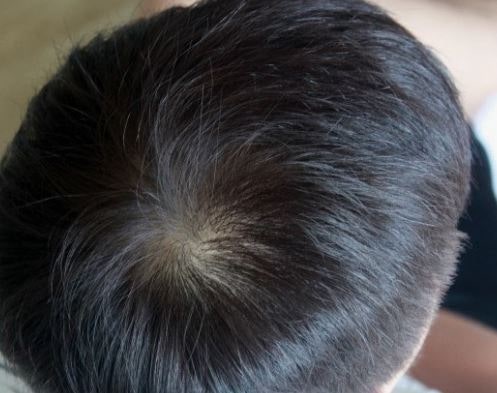 머리숱 없는, 많아지는, 없어지는, 빠지는, 빠진 꿈 해몽