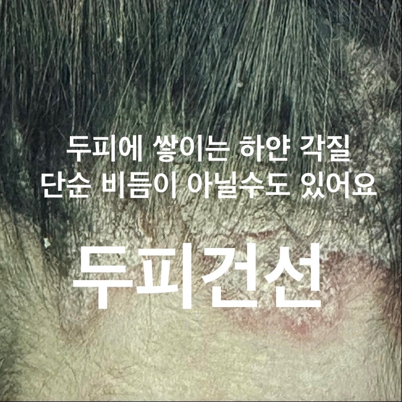 두피건선 치료 증상 원인까지 대구 칠곡 장재원 피부과 의원