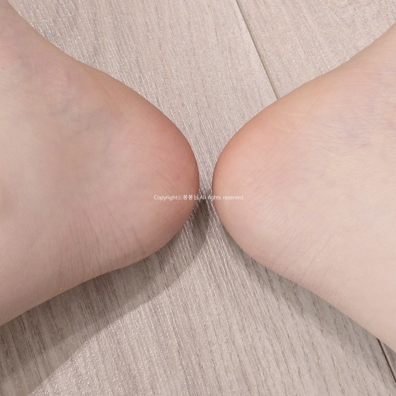 샌들 신을 준비 중! 발뒷꿈치 굳은살 뒤꿈치 각질제거 발라봄