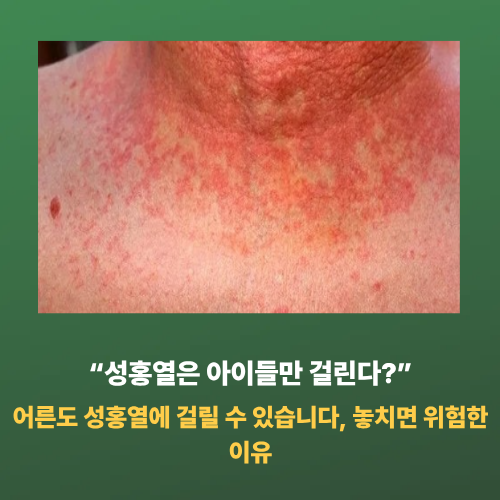 “성홍열은 아이들만 걸린다?”어른도 성홍열에 걸릴 수 있습니다, 놓치면 위험한 이유