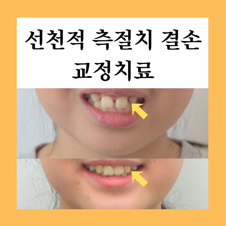  중랑구교정치과, 측절치 결손 + 돌출 고민 교정으로 해결할 수 있을까요?