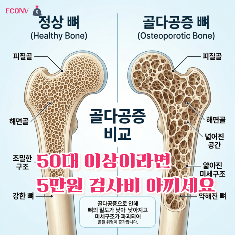 50대 이상이라면 병원 가지 마세요 보건소 골다공증 검사 무료입니다