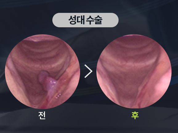 목소리 쉬고 갈라진다면 대구 성대결절 증상 의심, 초기 치료가 중요한 이유