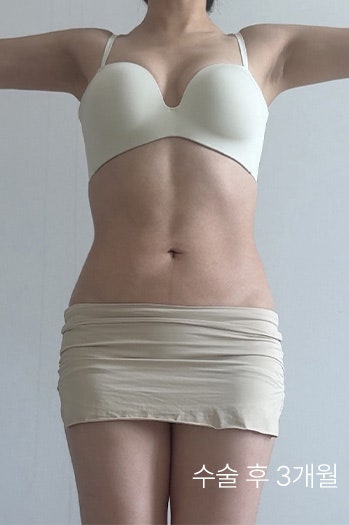  복부지방흡입비용 아깝지 않은 확실한 전후 후기! SVF복부지방흡입