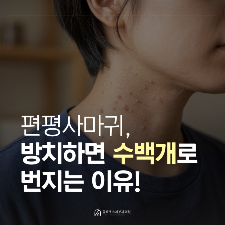  수원 편평사마귀, 방치하면 수백개로 번지는 이유!