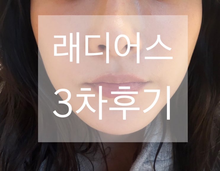  [내돈내산] 결국 레디어스로 돌아온 이유! 3차 시술 후기 (feat. 쥬베룩 볼륨 비교)
