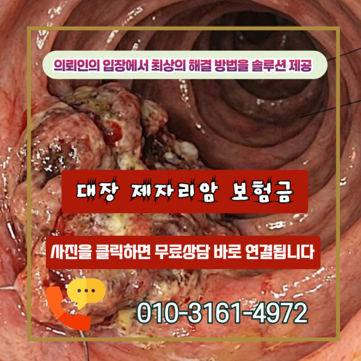  대장 제자리암 보험금, 10%만 받고 끝내실 건가요? 일반암 100%받은 실제 사례