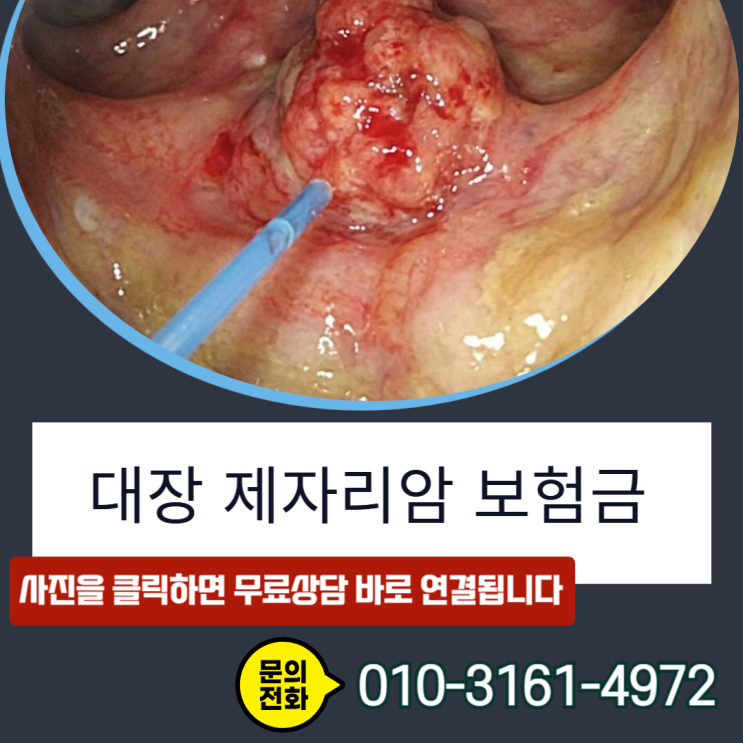  대장 제자리암 보험금, D01 코드인데 10%만? 손해사정사가 밝히는 100% 보상 기준
