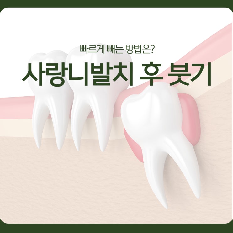 사랑니발치 후 붓기, 빠르게 빼는 방법은?