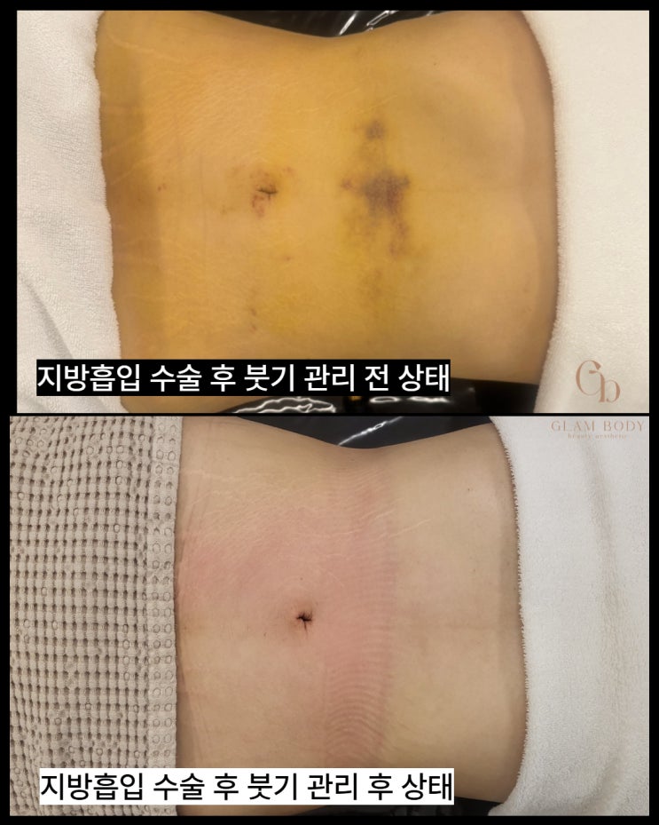  지방흡입 붓기 언제 빠지나요? 2주차부터 관리 5회차까지 변화