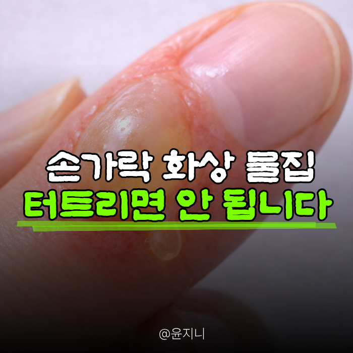 손가락 화상 물집 생겼을 때, 터트리기 전에 꼭 알아야 할 것