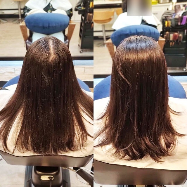  오산에서 오신 여성고객님 가르마 갈라짐 고민, 뒤통수까지 휑해 보이는데 링거펌 모류교정으로 채워질까요?