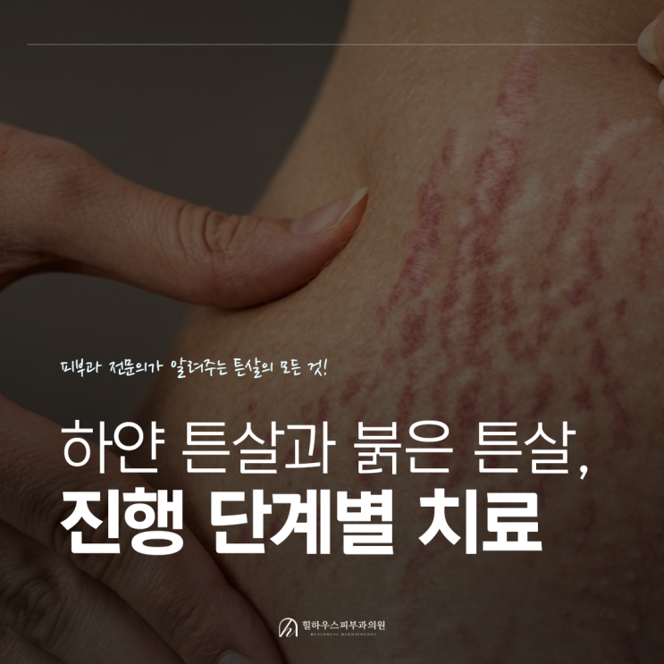  수원 튼살 피부과 하얀튼살과 붉은튼살 제거 치료