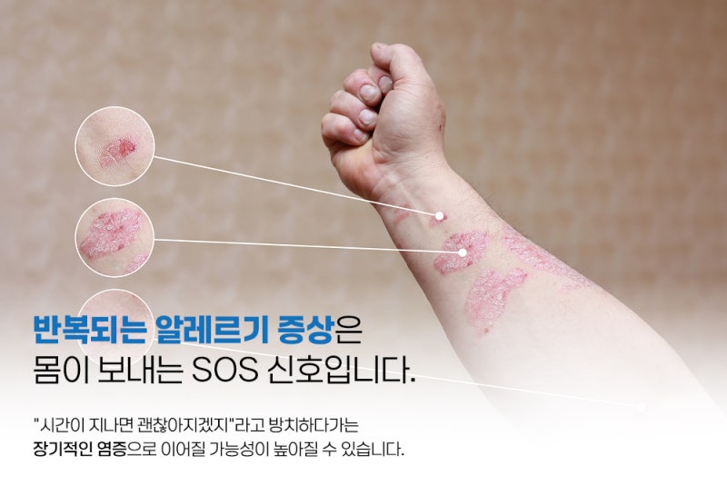 대구MAST검사로 알러지 원인 한 번에 확인해 보세요!
