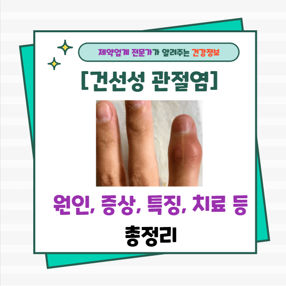 [건선성 관절염] 원인, 증상, 특징, 치료 등 "총정리"