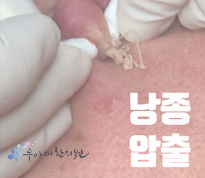 소음순 뾰루지, 팬티라인 종기로 커지는 경우 있습니다