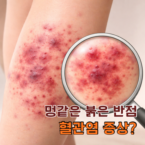 멍처럼 보이는 피부 붉은 반점, 혈관염 증상일 수 있습니다
