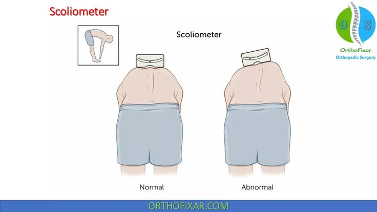  학교 척추검사에서 ‘척추측만 의심’이라고 하면 어떻게 해야할까