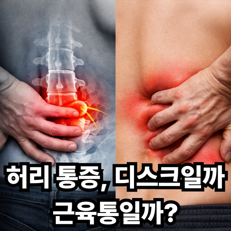  허리 디스크와 허리 근막통증 증후군 차이, 헷갈리기 쉬운 허리 통증 구분법