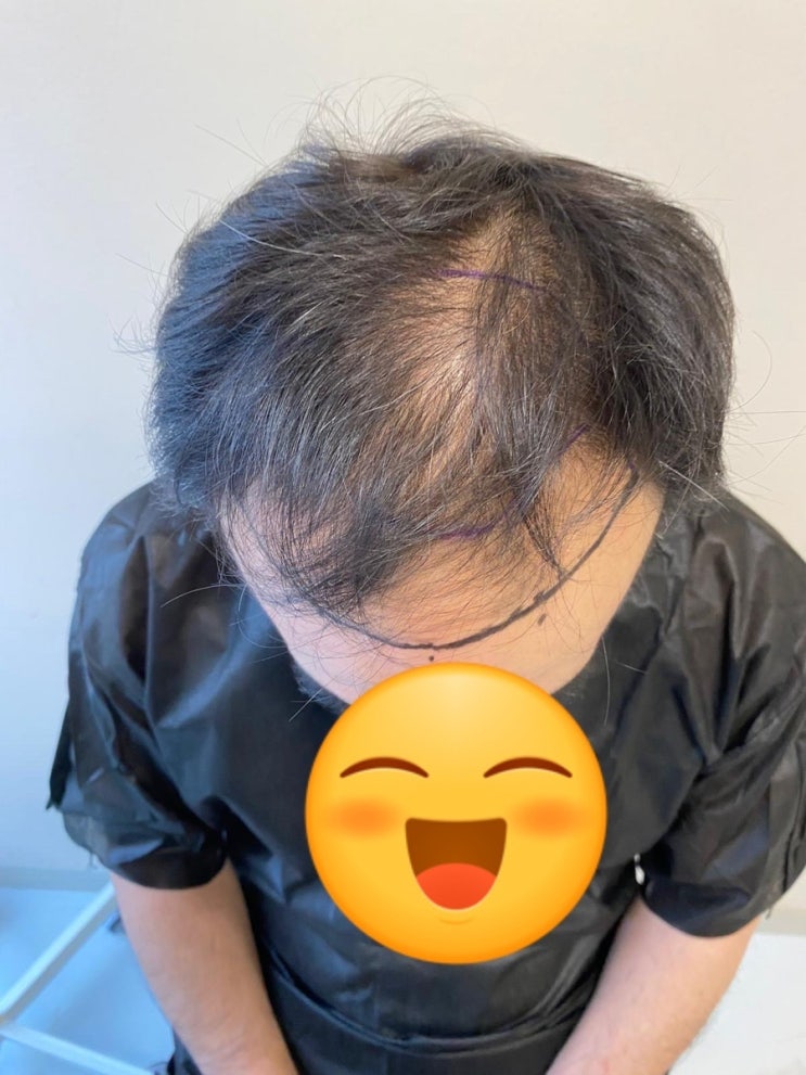  터키 비절개 모발이식 8000모 어느정도 일까요?