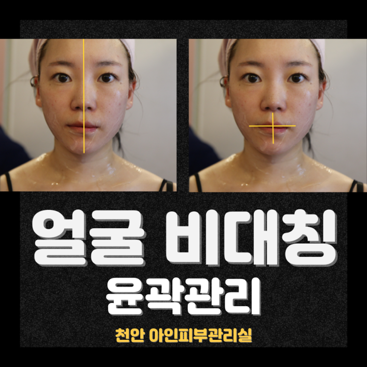  얼굴 비대칭이 생기는 이유와 비대칭 관리 방법｜천안 신부동 피부관리