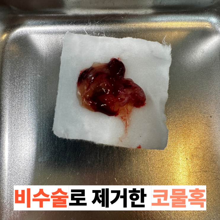  코물혹이란 무엇인가요? 코물혹 진단 받으셨다면 읽어보세요 코물혹 한의원 비수술 치료법까지