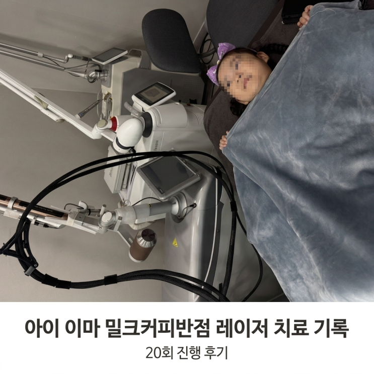  아이 이마 밀크커피반점 레이저 치료 기록 (20회 진행 후기)