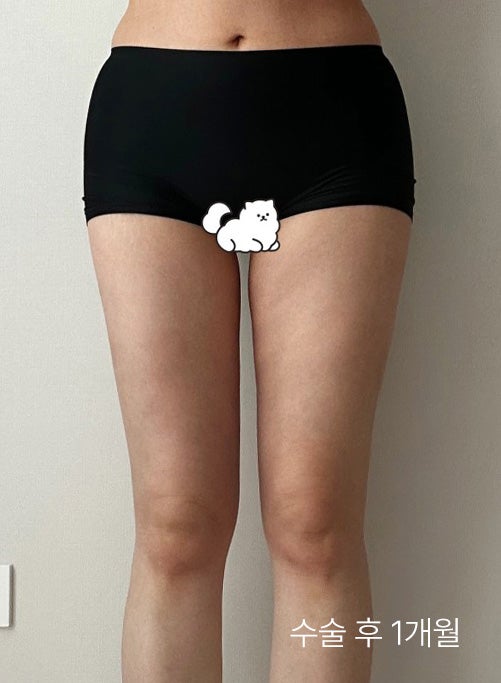  강남허벅지지방흡입 후기 고민 끝에 결정한 이유