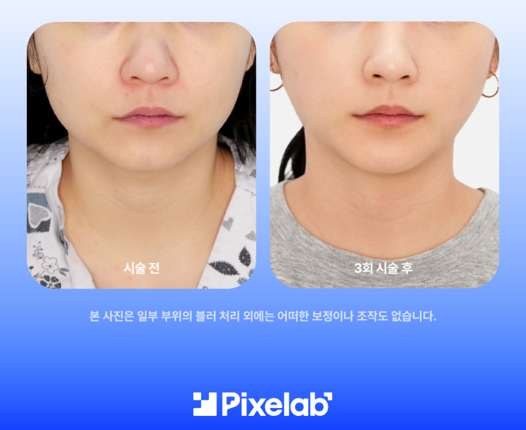  울쎄라피 효과 언제부터 나타나는지 궁금하신가요? 성형외과 전문의가 정리해 드리는 3가지 체감 기준