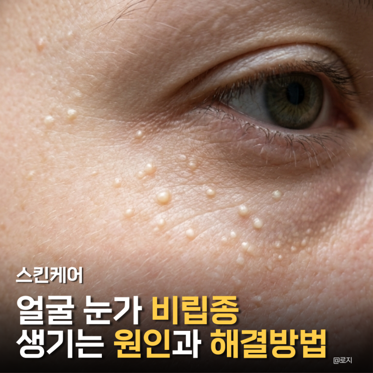 얼굴 눈밑 눈가 비립종 생기는 원인과 없애는 방법