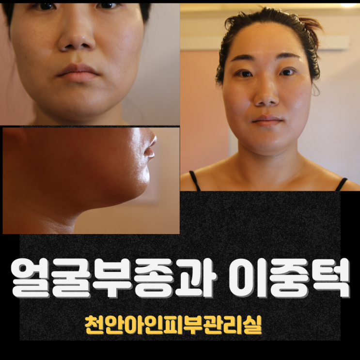  얼굴을 작게 만드는 방법 얼굴부종 윤곽관리｜얼굴 붓기와 림프순환 천안 신부동 피부관리