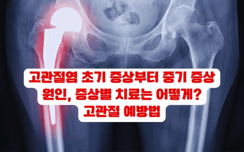 고관절염 초기증상 통증 원인 치료 약 수술 고관절염 예방법