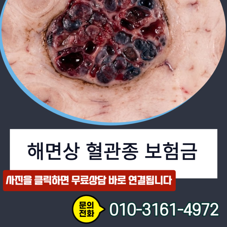  해면상 혈관종 보험금, 뇌출혈 진단비 거절됐는데 뒤집은 실제 대응 전략 3가지