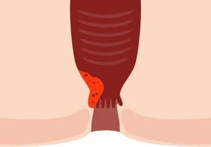 항문 냄새 원인 치질일 때 확인하는 방법