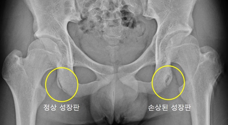  성장기 운동선수에게 생기는 햄스트링 건열골절 - 증례와 함께 알아보기
