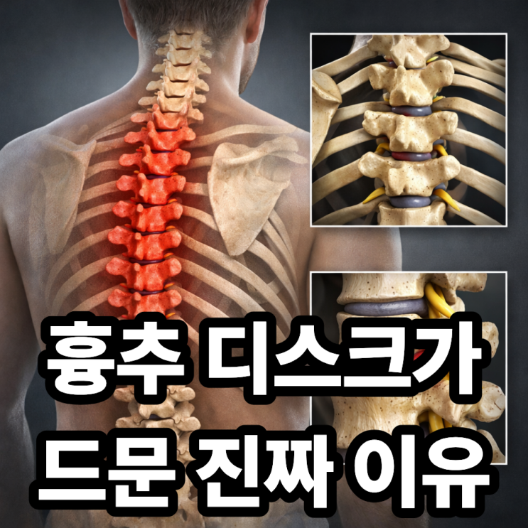  흉추 디스크가 드문 이유, 목·허리 디스크와 무엇이 다를까?