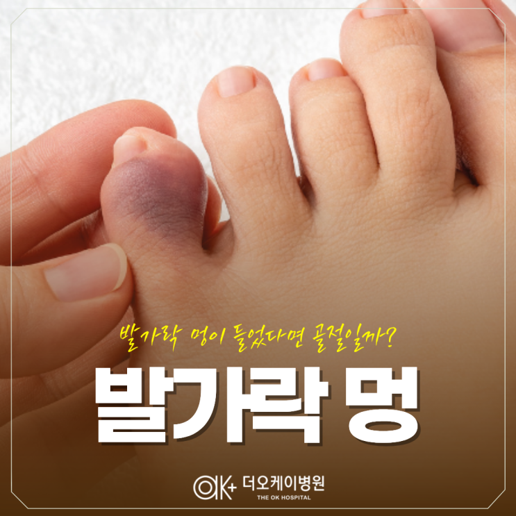  춘천정형외과, 발가락 멍이 들었다면 골절일까?