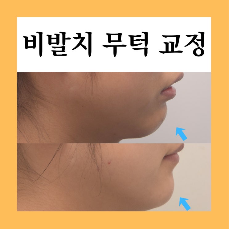 쌍문역교정치과, 비발치 무턱 개방교합 교정