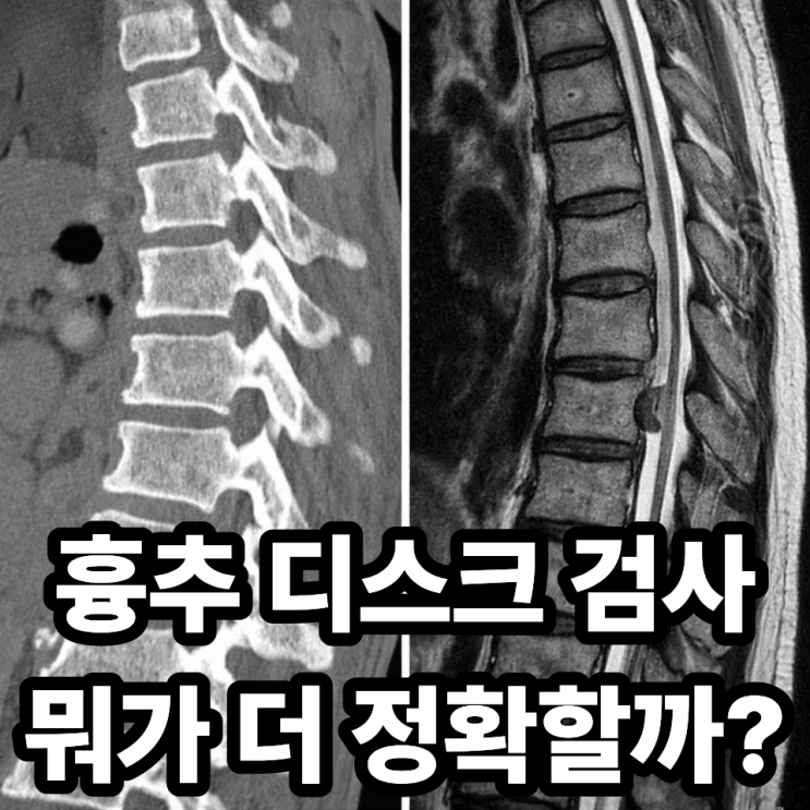 흉추 디스크 CT와 MRI 차이, 어떤 검사가 더 정확할까?