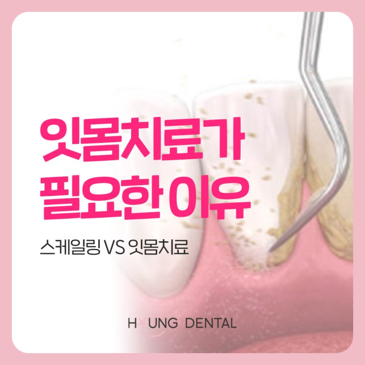  영통 수원치과가 말하는 잇몸치료가 필요한 이유