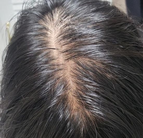 아윤채 샴푸 종류 지성두피용 탈모용 사용후기