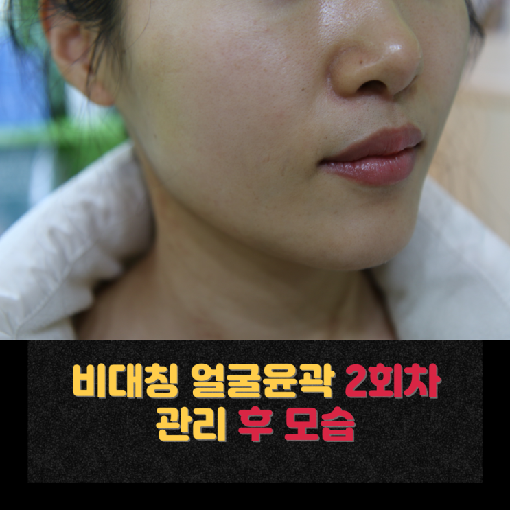  얼굴 비대칭이 생기는 이유와 윤곽관리의 필요성｜천안 신부동 피부관리