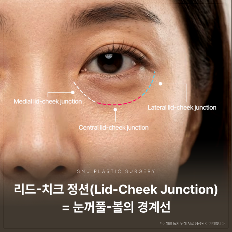 스누성형외과｜다크서클과 눈밑지방, 제거만이 답일까?