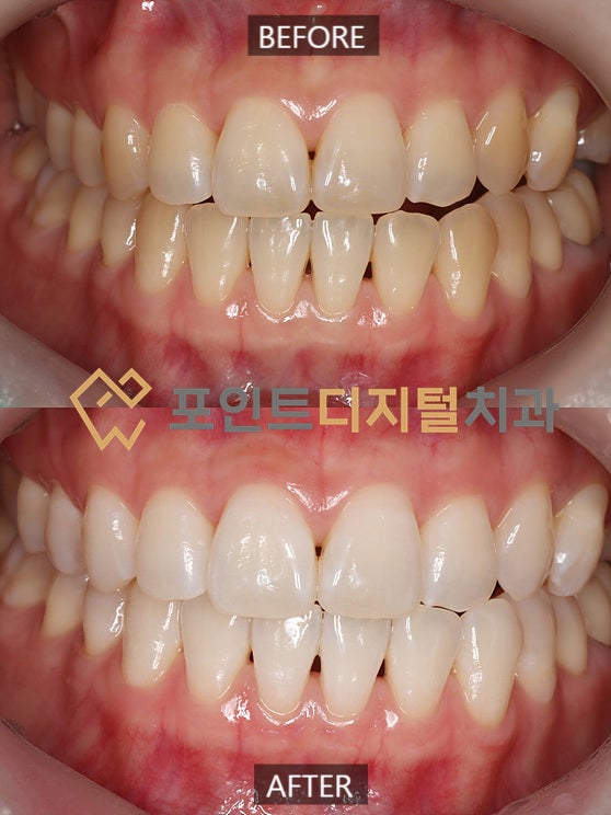 [탕정치과]  치아미백 A4 → B1 밝기 상승, 라미네이트 없이 이정도까지 가능(미백폭발 코스) / 천안 아산 탕정 불당 배방