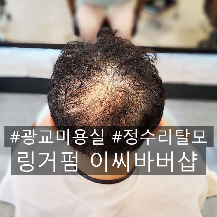  광교 정수리 탈모 링거펌 30대 남자 정수리 비침 고민, 모류교정으로 꽉 채운 리얼 후기