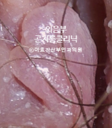 질전정유두종 vs 곤지름 사마귀, 아직도 헷갈려요