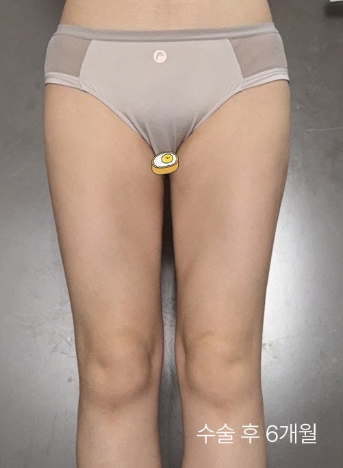 허벅지지방흡입후기 속 통증, 붓기, 효과? 전후 라인 변화와 만족도가 높은 이유