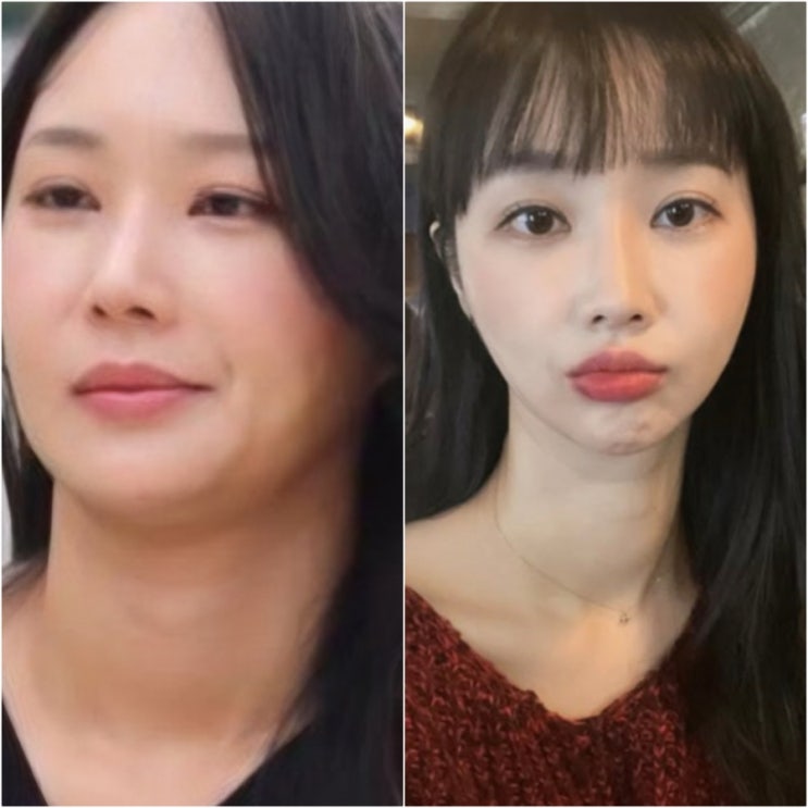  심각할 정도로 본인 외모에 만족하던 나솔 24기 옥순 병원서 '수술로 될 얼굴 아니다' 충격